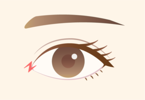 目頭切開法（内眦形成術）  U CLINIC SHINJUKU