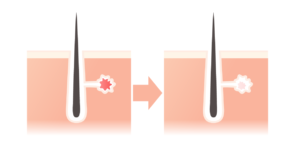 Pdt フォトダイナミックセラピー 治療 U Clinic Shinjuku