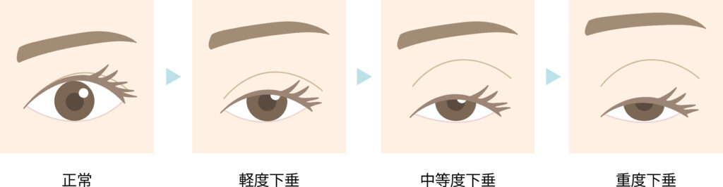 眼瞼下垂の症状の重症度