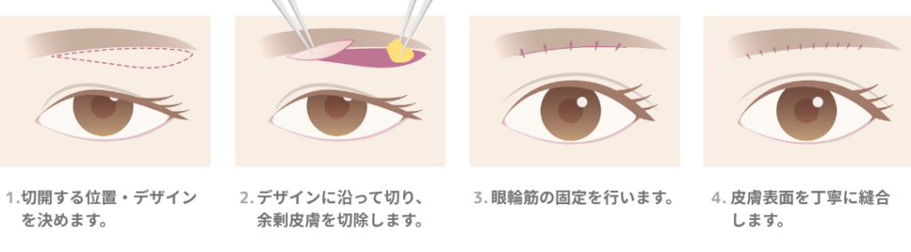 眉下切開治療の説明イラスト